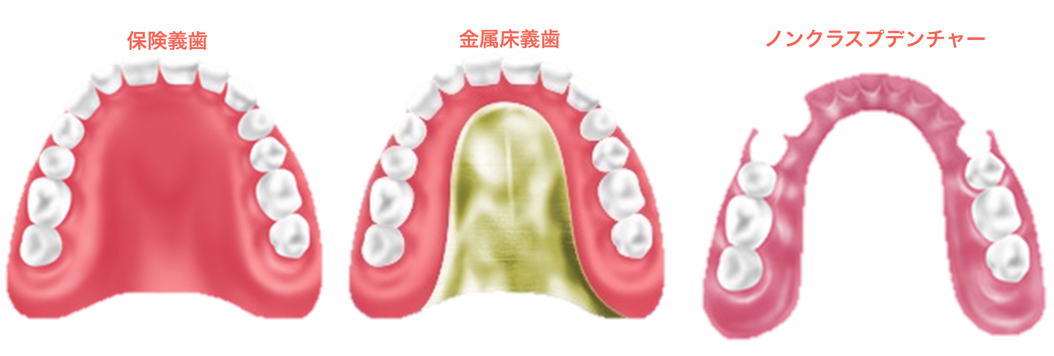 入れ歯について