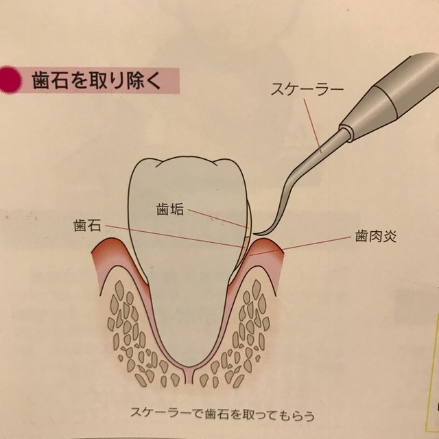 歯周病（歯槽膿漏、歯周炎）の治療・予防