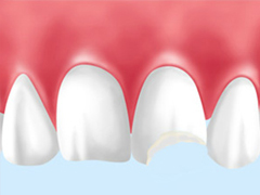 歯の破折について