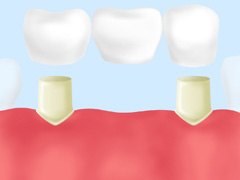 ブリッジ（さし歯）・入れ歯・インプラント