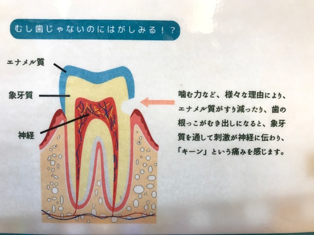 知覚過敏