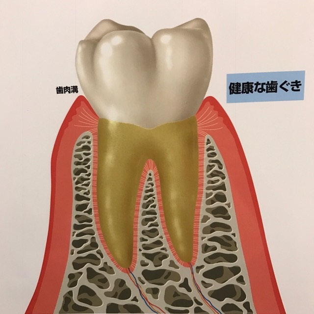 歯周病（歯槽膿漏、歯周炎）について