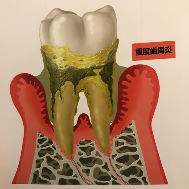 歯周病（歯槽膿漏、歯周炎）について