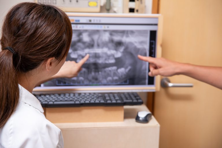 歯のレントゲン写真